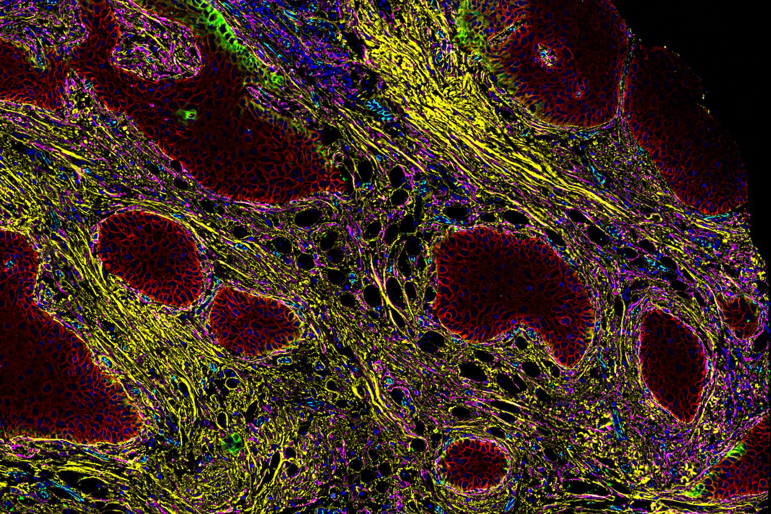 A multicolor microscopic view of tumor cells, showcasing intricate biological details.