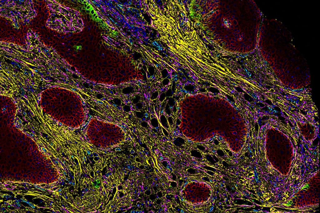 A multicolor microscopic view of tumor cells, showcasing intricate biological details.