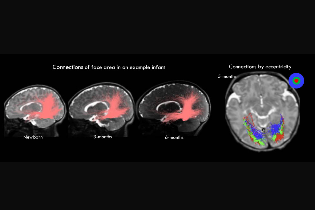 White matter connections of a face area measured with diffusion magnetic resonance imaging (dMRI) in the same baby over 6 months illustrate both the innate and developing aspects of connections in the human brain.