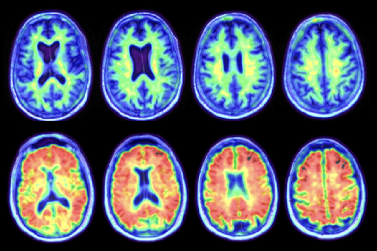 PET scans of brains show that healthy older APOE4 carriers are much more likely to be amyloid-positive than non-carriers.