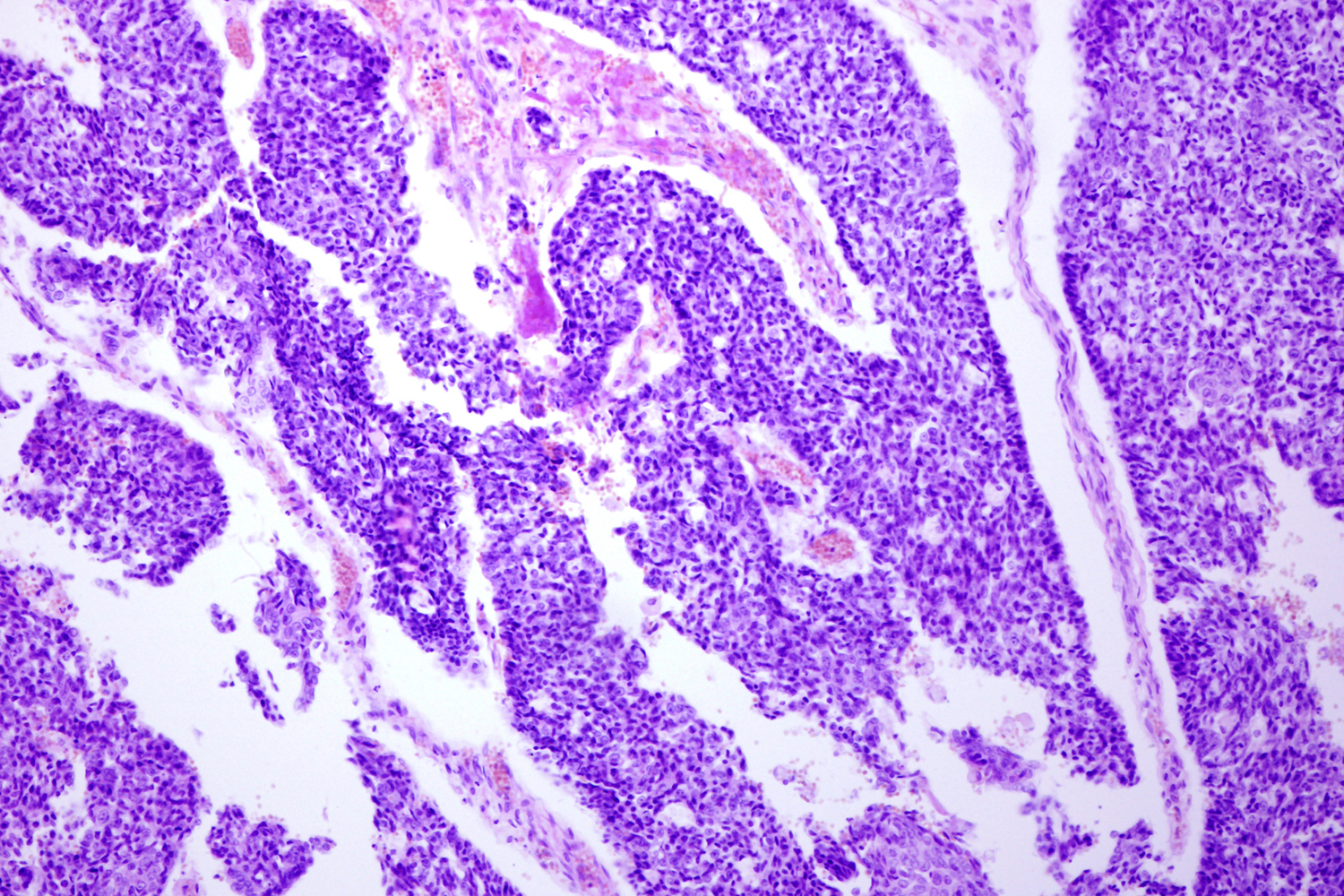 Microscope view of stained tissue showing dense clusters of purple cell nuclei separated by pale pink strands and open white gaps.