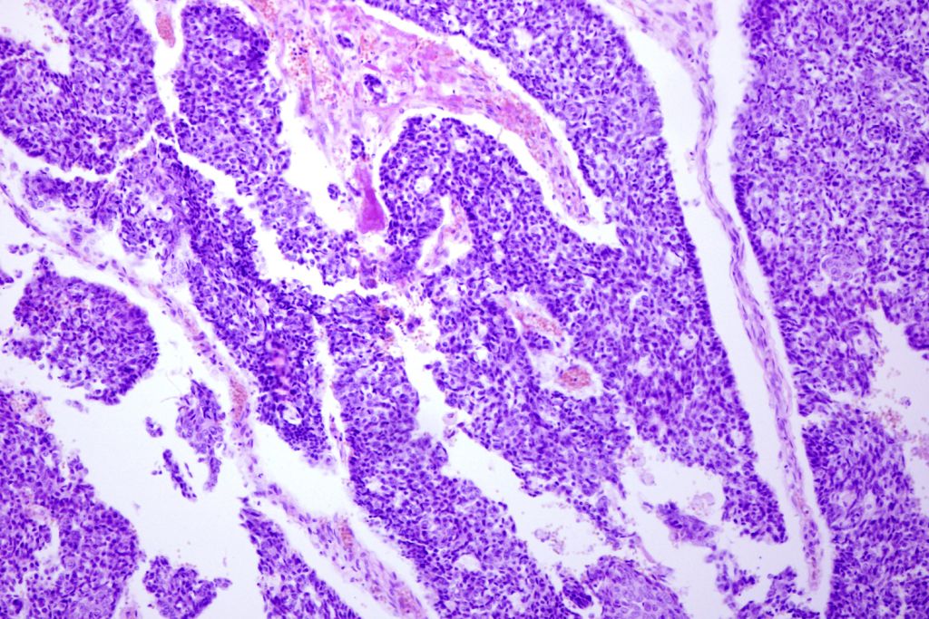 Microscope view of stained tissue showing dense clusters of purple cell nuclei separated by pale pink strands and open white gaps.
