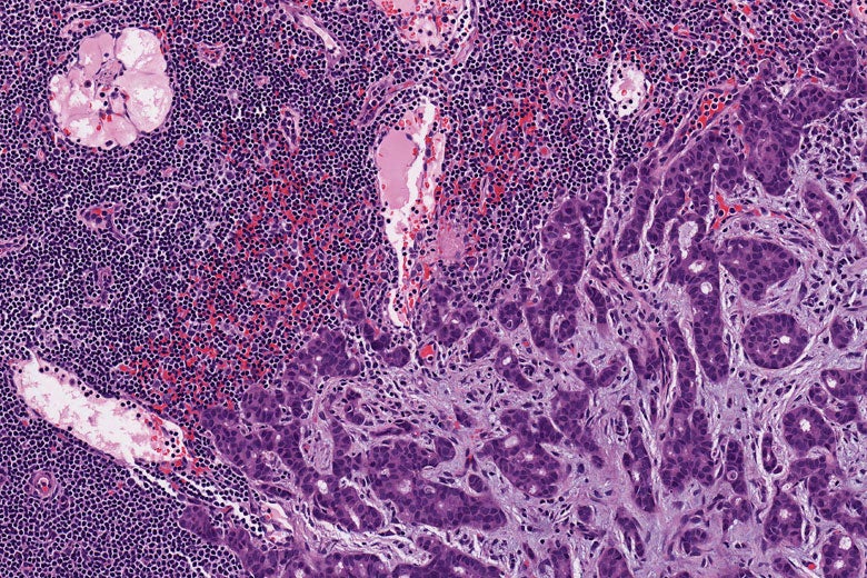 formaldehyde-preserved cancer cells