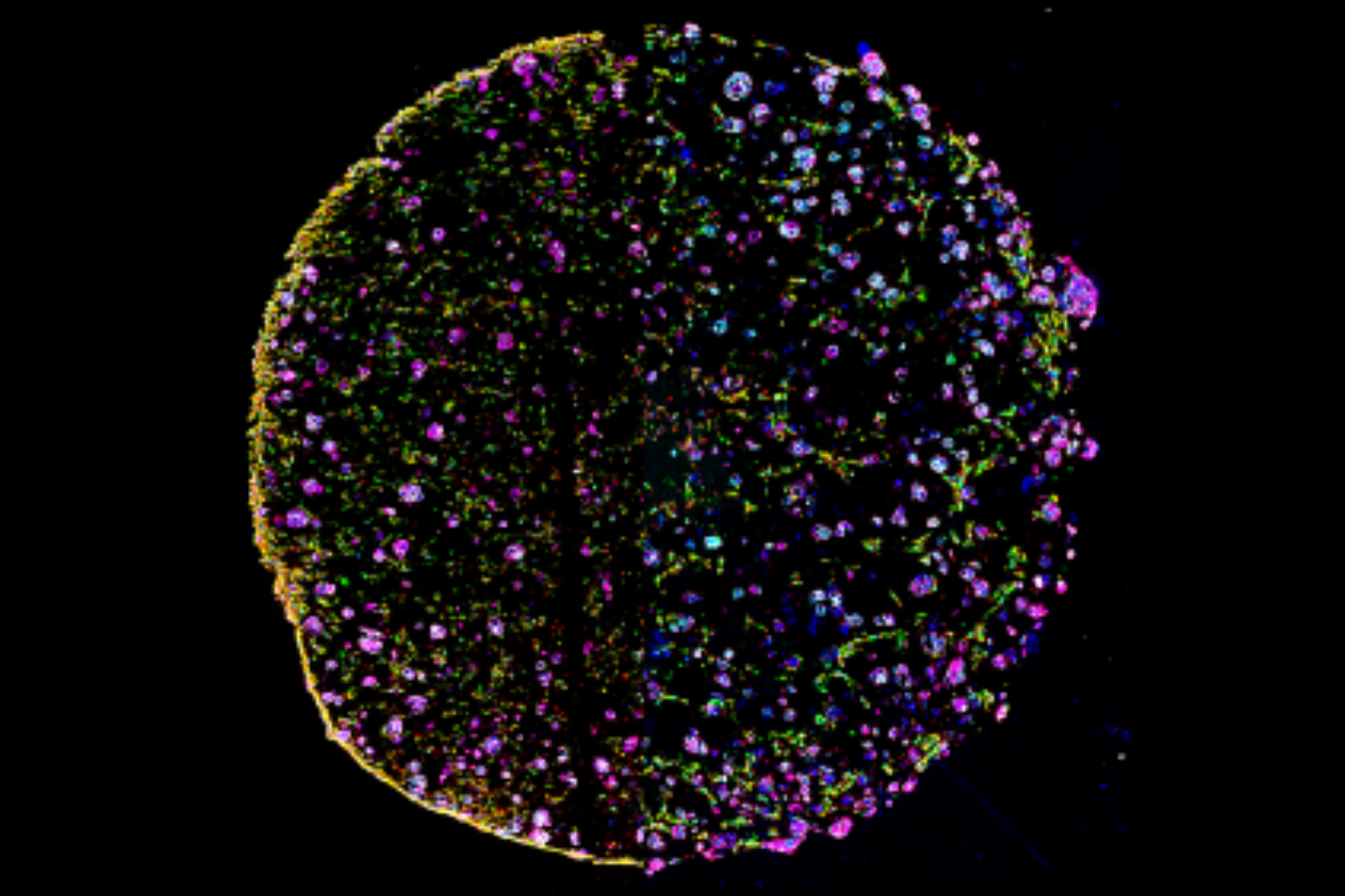 Fibroblasts harvested from the tumor edge sort into the left edge of the model; on the right, tumor core fibroblasts reorganize more evenly — suggesting that they may be better adapted to survive in the “hostile” tumor core.