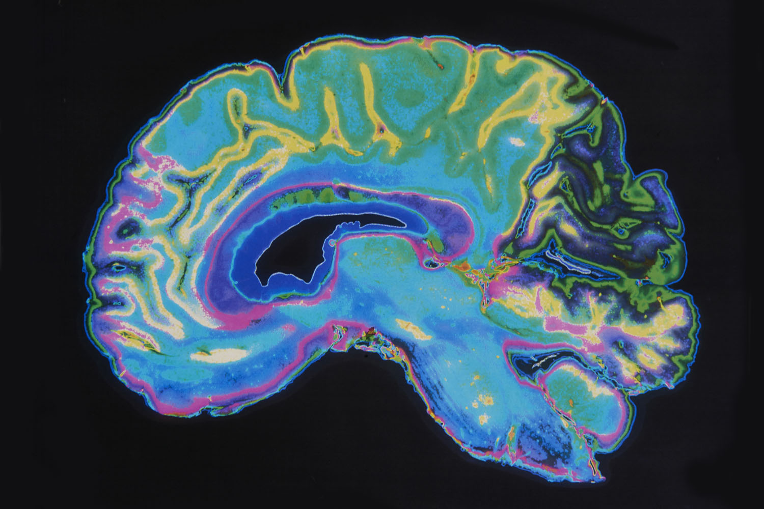 Brightly colored sagittal MRI brain scan in neon blue, green, pink, and yellow on black.