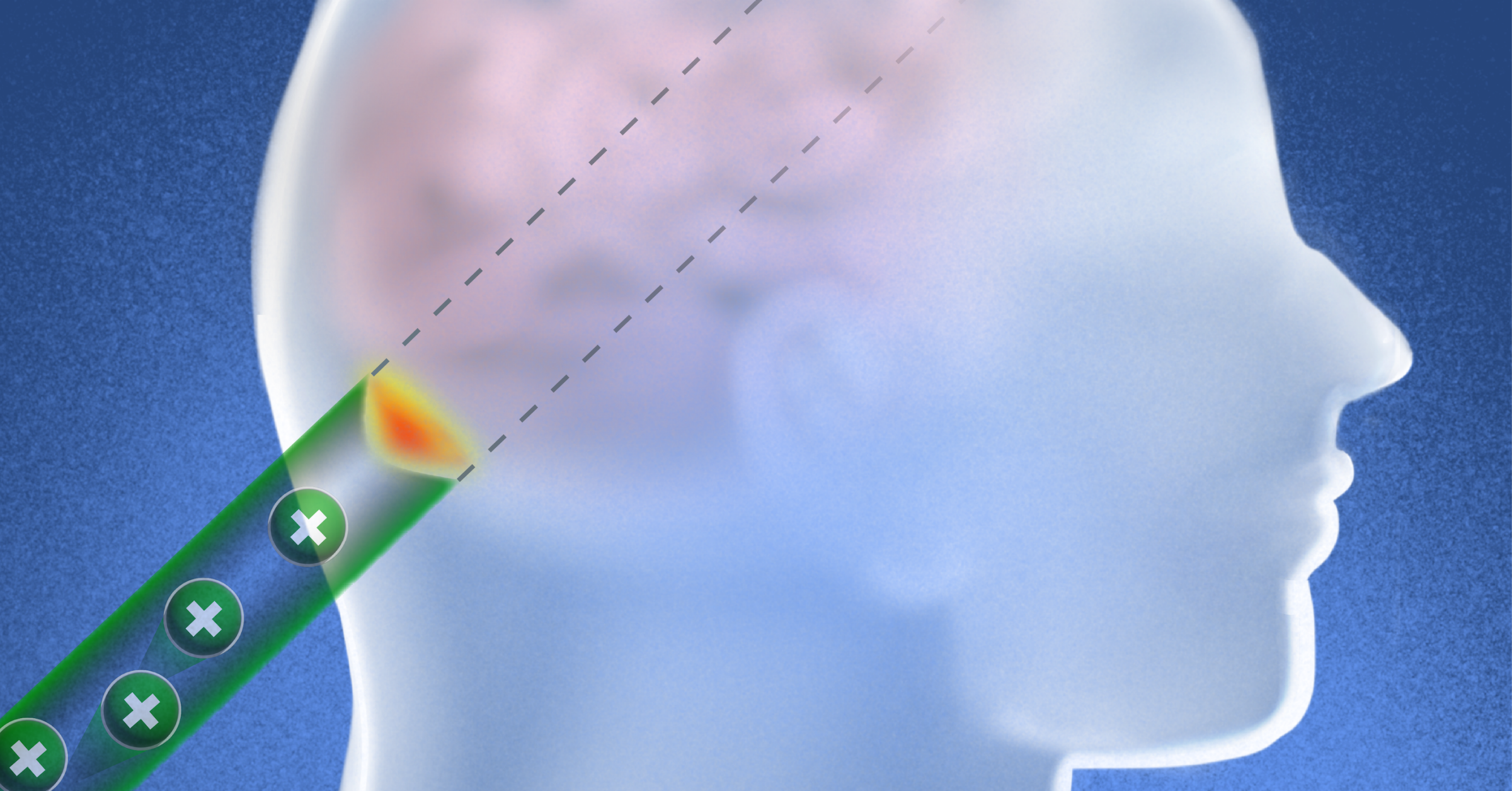A digital illustration showing a brain and a scanning device targeting a specific area, indicating advanced medical imaging technology.