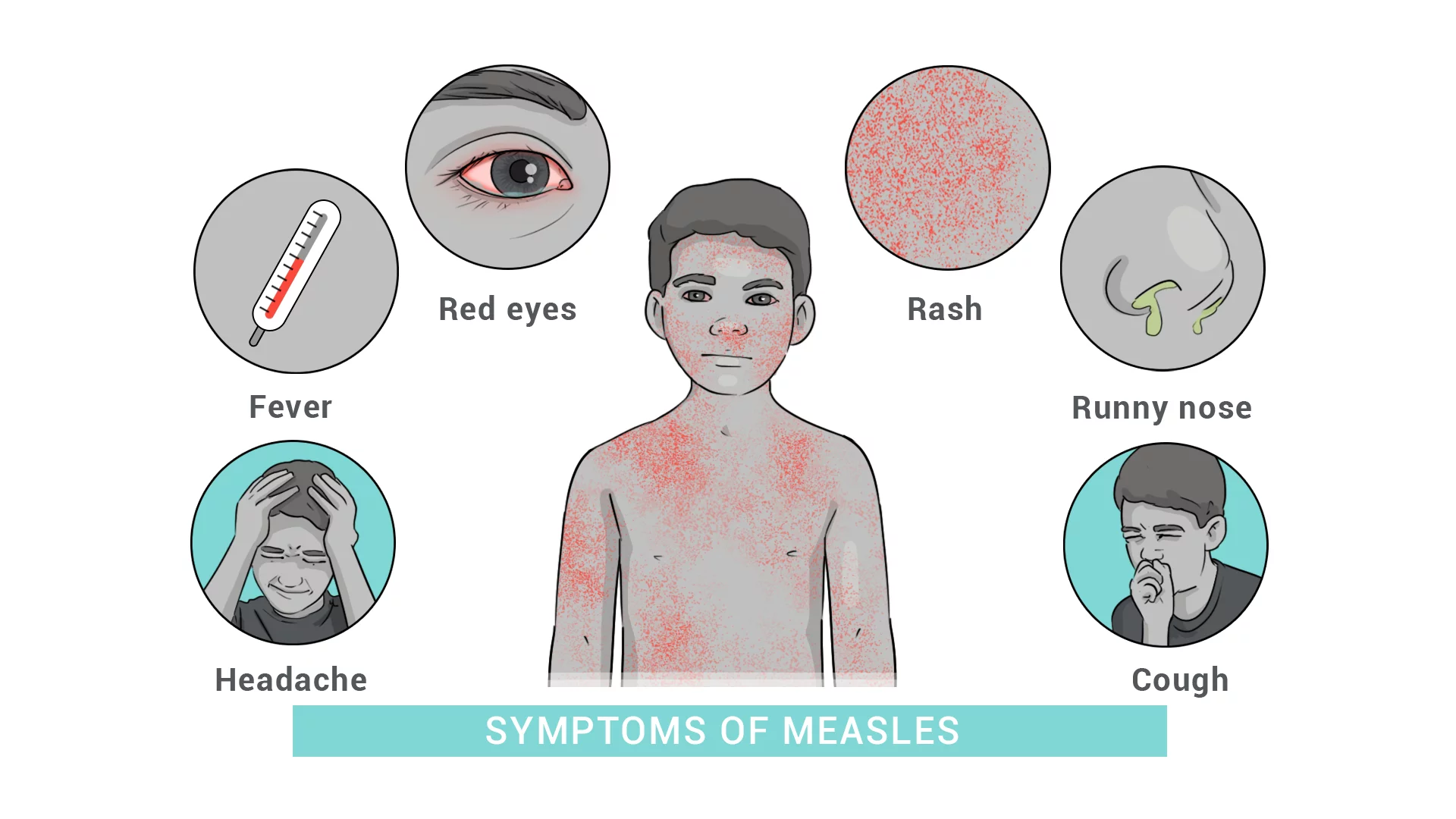 Graphic illustrates symptoms of measles: headache, fever, red eyes, rash, runny nose, cough.