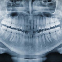 panoramic x-ray of a healthy jaw