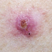 image of basal cell carcinoma. A new study from Stanford shows that people who develop six or more basal cell carcinomas during a 10-year period are more likely to develop other, unrelated cancers.
