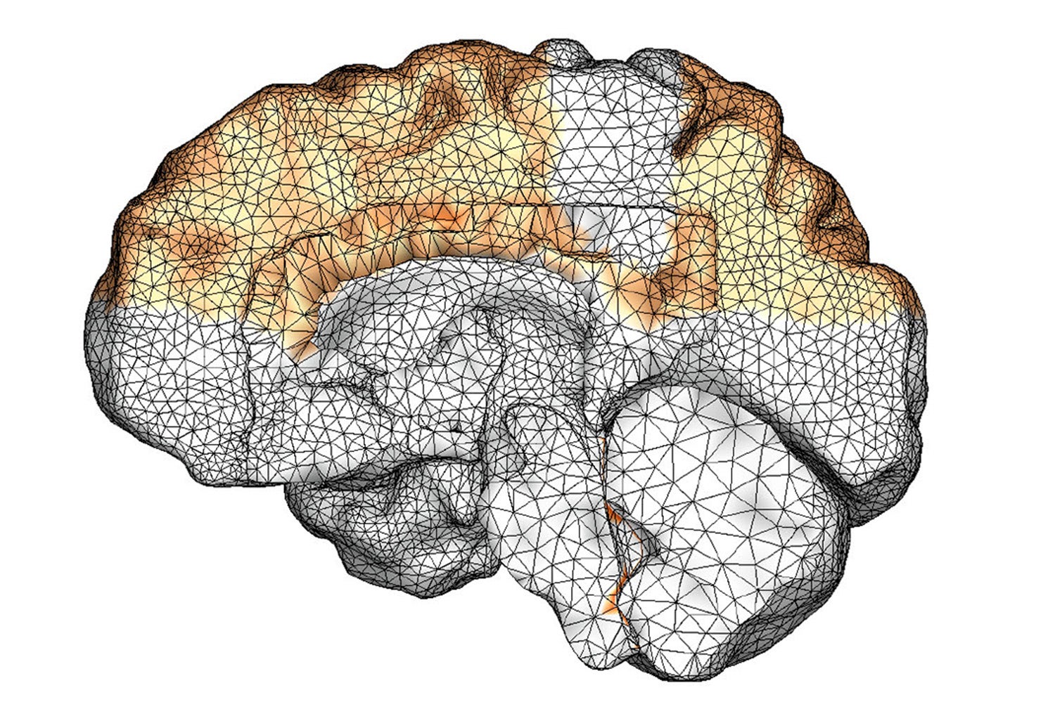 image of a computer model showing amyloid beta proteins throughout brain in dementia cases