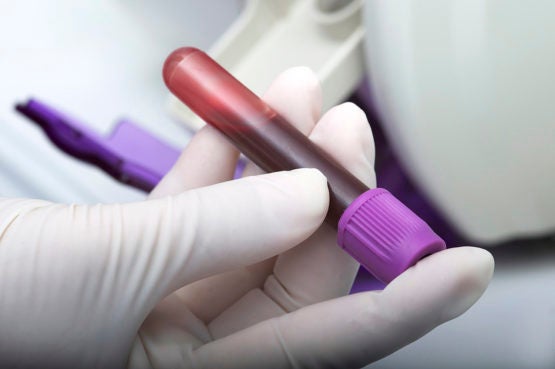 Blood sample in tube
