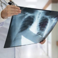 doctor checking chest x-ray film