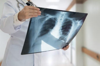 doctor checking chest x-ray film