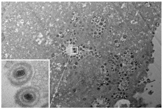 transmission electron microscope image shows the varicella-zoster virus
