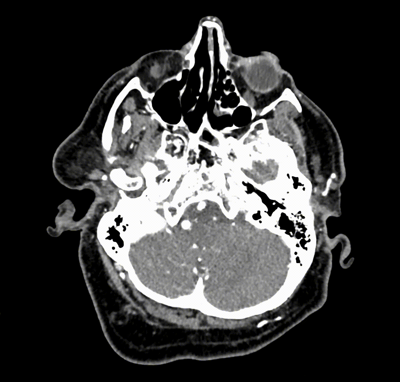 In this brain scan, the location of an aneurysm is indicated by HeadXNet using a transparent red highlight.